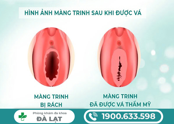 Hình ảnh minh họa