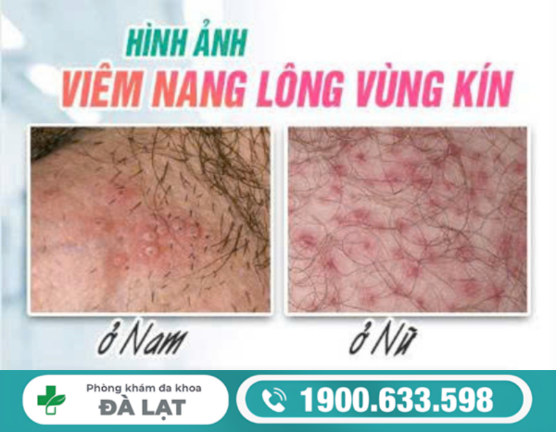 Hình ảnh minh họa