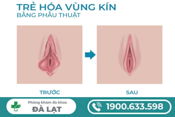 Hình ảnh minh họa